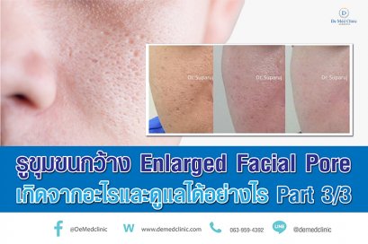 รูขุมขนกว้าง Enlarged Facial Pore เกิดจากอะไรและดูแลได้อย่างไร Part 3/3
